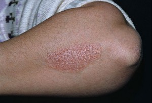 dermnet_rf_photo_of_chronic_psoriasis_on_arm