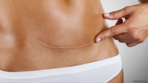 150710134532_cesarea_1_624x351_thinkstock