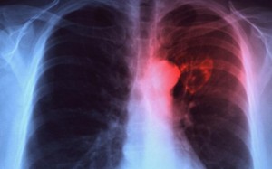 tuberculosis3_1